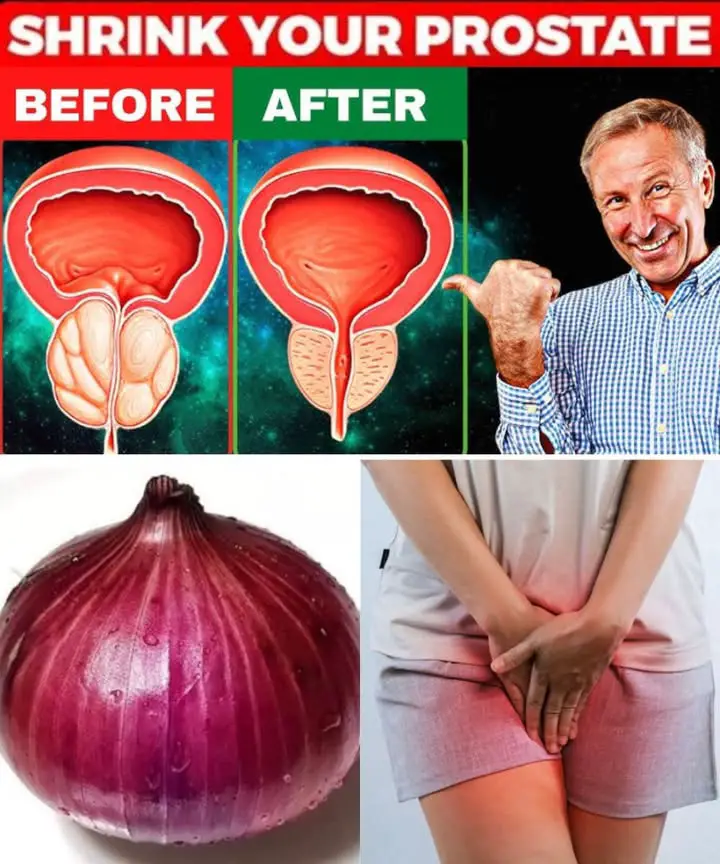 rimedi naturali cipolla prostata