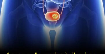 cancro alla vescica segnali