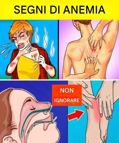 Anemia