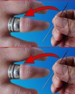 Come Rimuovere Facilmente Un Anello Incastato Dal Dito Con Un Ago