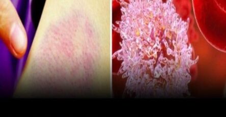 7 Primi Segnali di Tumore del Sangue Che Tutti Dovrebbero Conoscere