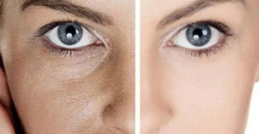 Crema al bicarbonato di sodio riduce rughe macchie e acne