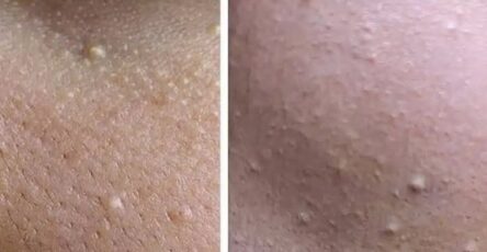 Palline bianche sulla pelle: cosa significano?