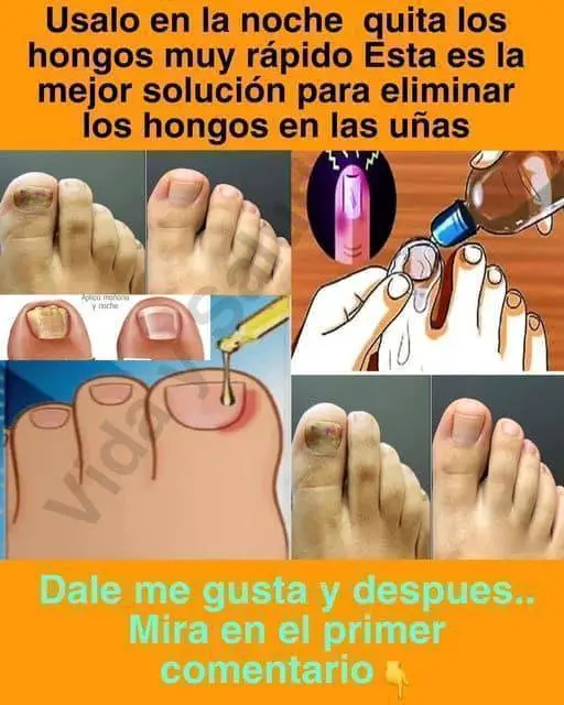 Remedio para los hongos